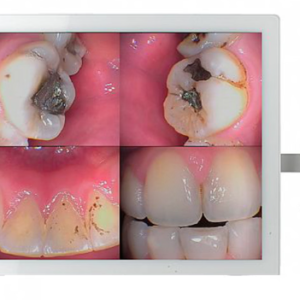 CAMARA INTRAORAL